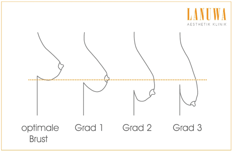 Schweregrade der Mastoptosis (Hängebrust) Schweregrade der Mastoptosis: optimale Brust, Grad 1, Grad 2, Grad 3