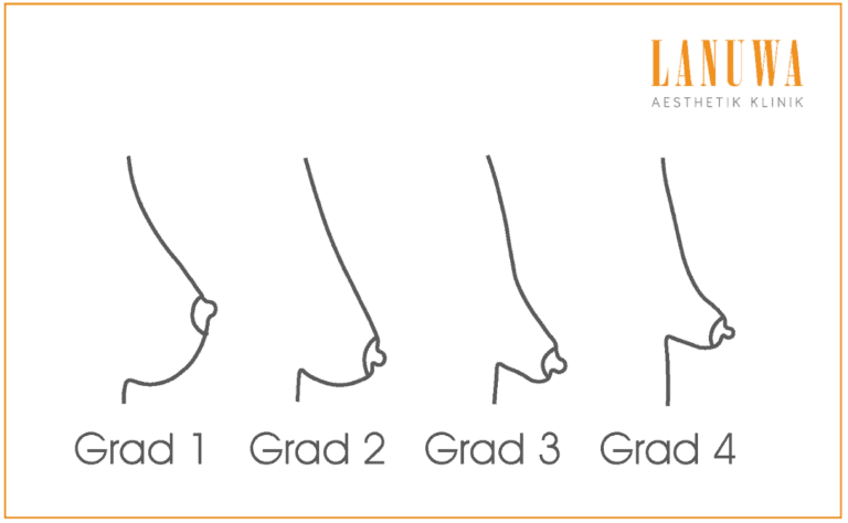 Schweregrade I-IV der tubulären Brust Die vier Grade der tubulären Brust: Grad 1 bis Grad 4