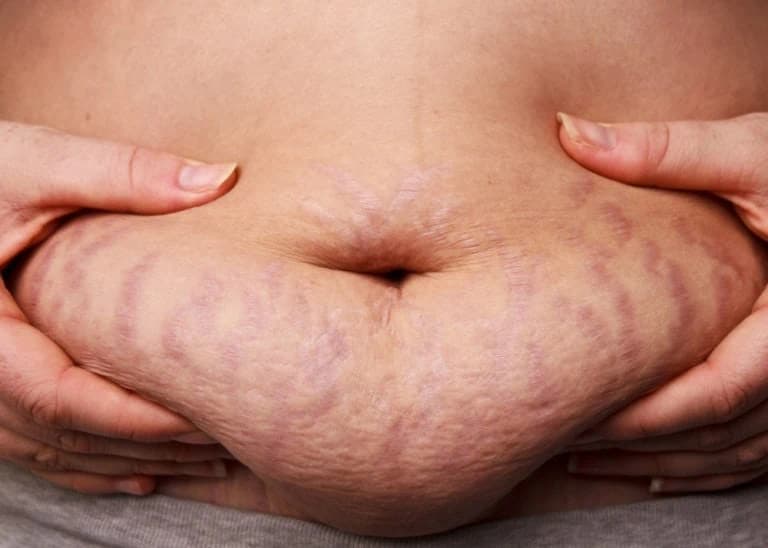 Dehnungsstreifen am Bauch Dehnungsstreifen am Bauch