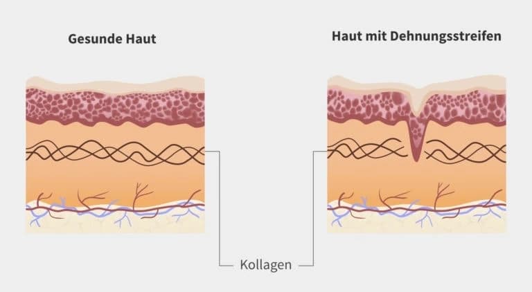 Entstehung von Dehnungsstreifen in der Haut durch überdehntes Bindegewebe und Risse der Kollagenfasern Entstehung von Dehnungsstreifen in der Haut durch überdehntes Bindegewebe