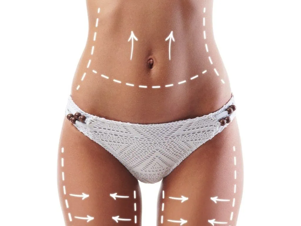 Behandlungsbereiche bei Fettabsaugung und Oberschenkelstraffung Behandlungsbereiche bei Fettabsaugung und Oberschenkelstraffung