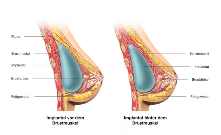 Schematische Darstellung: Implantat vor und hinter dem Brustmuskel Schematische Darstellung: Implantat vor und hinter dem Brustmuskel