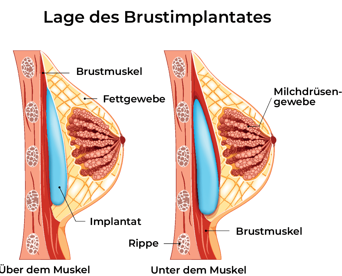 Brustimplantat-Platzierung: Über dem Muskel vs. Unter dem Muskel Brustimplantat-Platzierung: Über dem Muskel vs. Unter dem Muskel